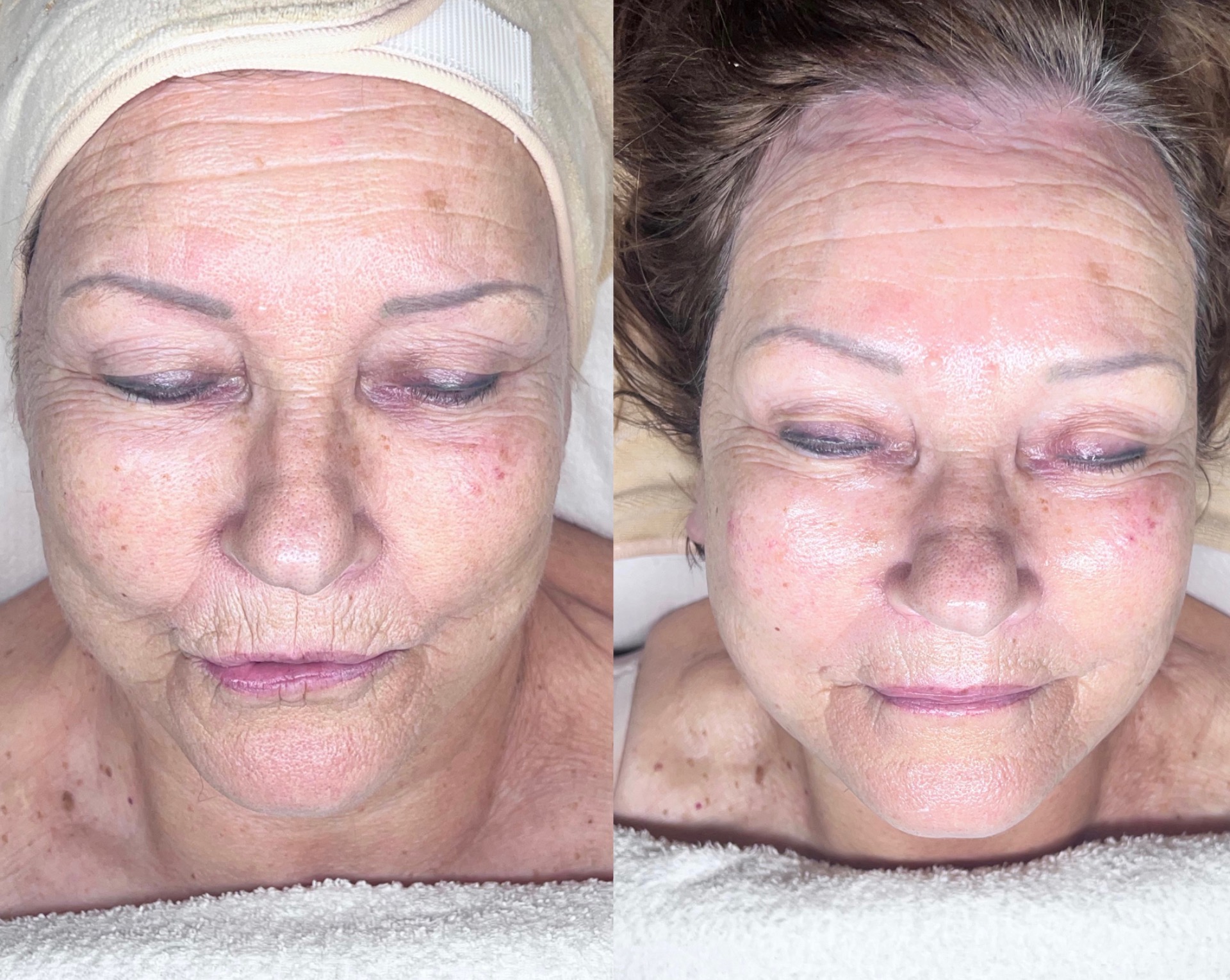 Shine & Glow -kasvohoito